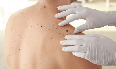 如何检测痣的位置是否危险?掌握4项规范,保障身体健康!