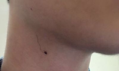 脖子右侧有颗痣上长毛会怎么样?