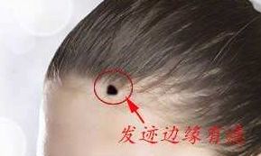 头发边缘有痣代表什么,发际线上有痣命运如何
