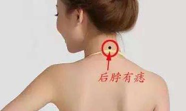 脖子后面有痣代表什么,脖子后面有痣图解
