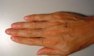 右手背有痣好不好 右手背有痣代表什么