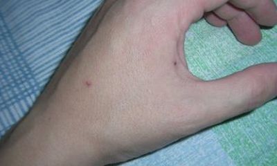 左手虎口有痣 右手虎口有痣 虎口有痣图解