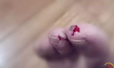 梦到脚指头出血