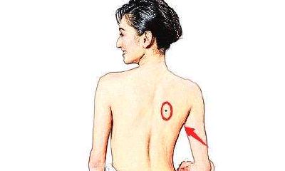 女生后背有痣图解大全