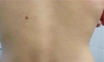 男人后背的左边有痣有什么特殊的含义