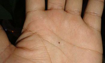 掌心痣代表什么含义