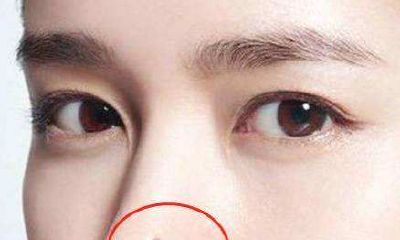 女生鼻子上有痣好不好