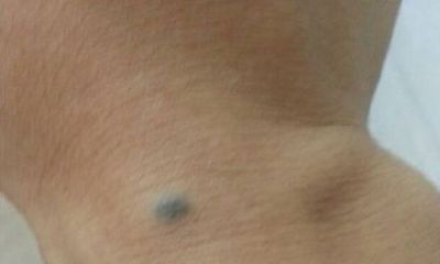 最新手部长痣解析大全