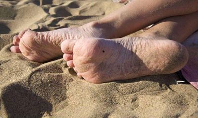 脚底下有痣代表什么