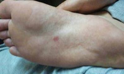 女人右脚底有朱砂痣命理好不好