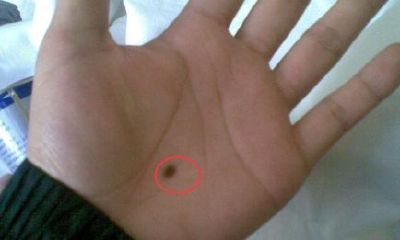 手上长痣都是幸运痣?