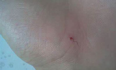 红痣长毛好吗?红痣长毛代表什么?