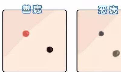 身上这四处有痣是财富的象征