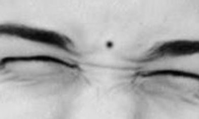 痣长在哪里会不好