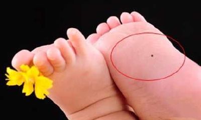 男人右脚底长痣好不好