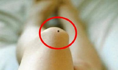 膝盖上有痣代表什么