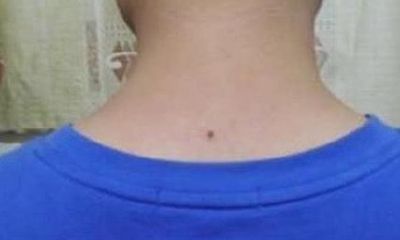 详解苦情痣和靠山痣的区别及其命运