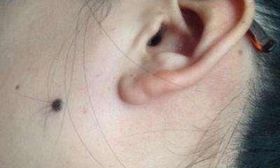 女生痣上长毛好不好,怎么办?