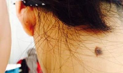 苦情痣图片大全