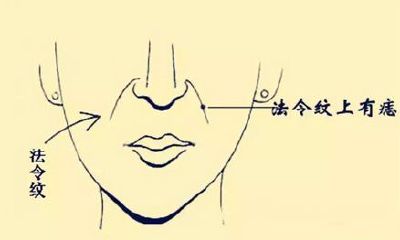 法令纹有痣