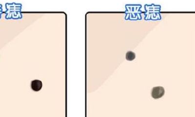 面部痣相图解:哪些痣影响事业发展