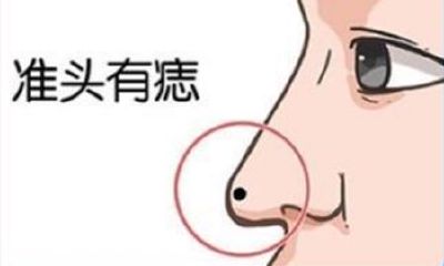 哪些痣是吉痣,预示着一个人好运临身,大富大贵呢