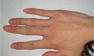 痣的位置与命运 手上有痣代表什么