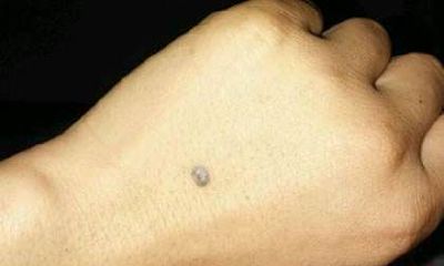 手背痣相图解 手背长痣代表什么