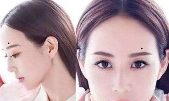 身上长一痣「房产痣」吉痣