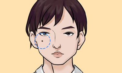 身上有痣别瞎点掉,尤其是这几个部位,也许你点掉的是财运痣