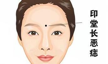 印堂恶痣,愿望不能成就,易失败,也是克夫之命痣