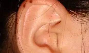 痣相长对,男富女贵,你的痣长对地方了吗