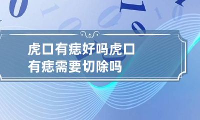虎口有痣好吗 虎口有痣需要切除吗