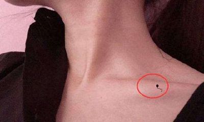 女人痣上长毛是好命吗