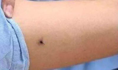 手臂痣上长毛命运怎么样