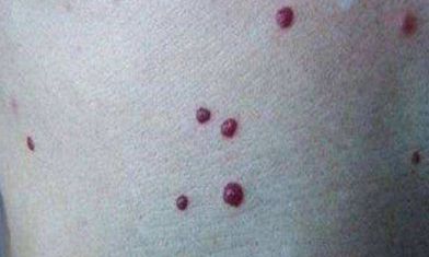 朱砂痣的传说是什么 教你如何区分朱砂痣