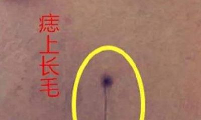 痣上长毛怎么去除,面相咋样