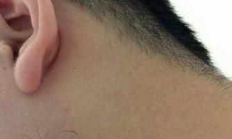 脖子痣上长毛说法是什么