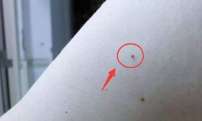 揭秘神奇的朱砂痣与其他痣的区别是什么?