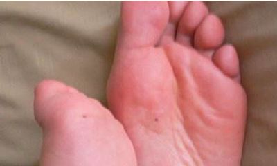 左脚底痣相图解 左脚底痣相的含义