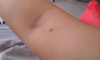 手臂痣的位置与命运 手臂痣的痣相分析