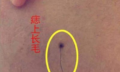 痣上长毛的是善痣么,痣相如何