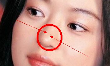 「痣」看命中运势,分析哪些是搜索小人的痣相,有限制的就点掉吗