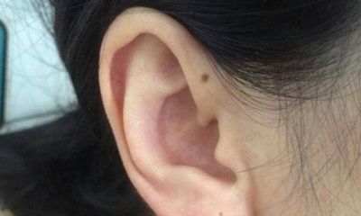 好痣可招贵人帮助, 恶痣则败尽家财, 那么耳朵上有痣, 到底是福还