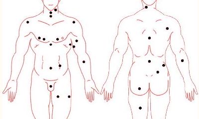 痣相吉凶速查 点痣必读要诀