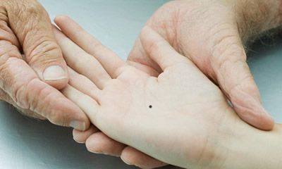 手心有痦子是什么意思