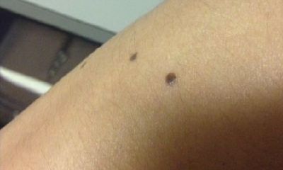 胳膊上的胎记说明什么意思