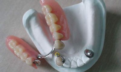 梦见掉很多牙齿是什么征兆女人(女人梦见掉牙没出血是凶兆吗)