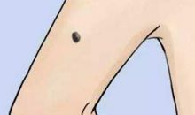 女人手臂有痣保富贵，你有吗？