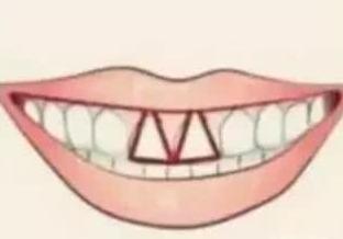测试：你的门牙属于哪种？看你天生是不是缺钱花！ 2